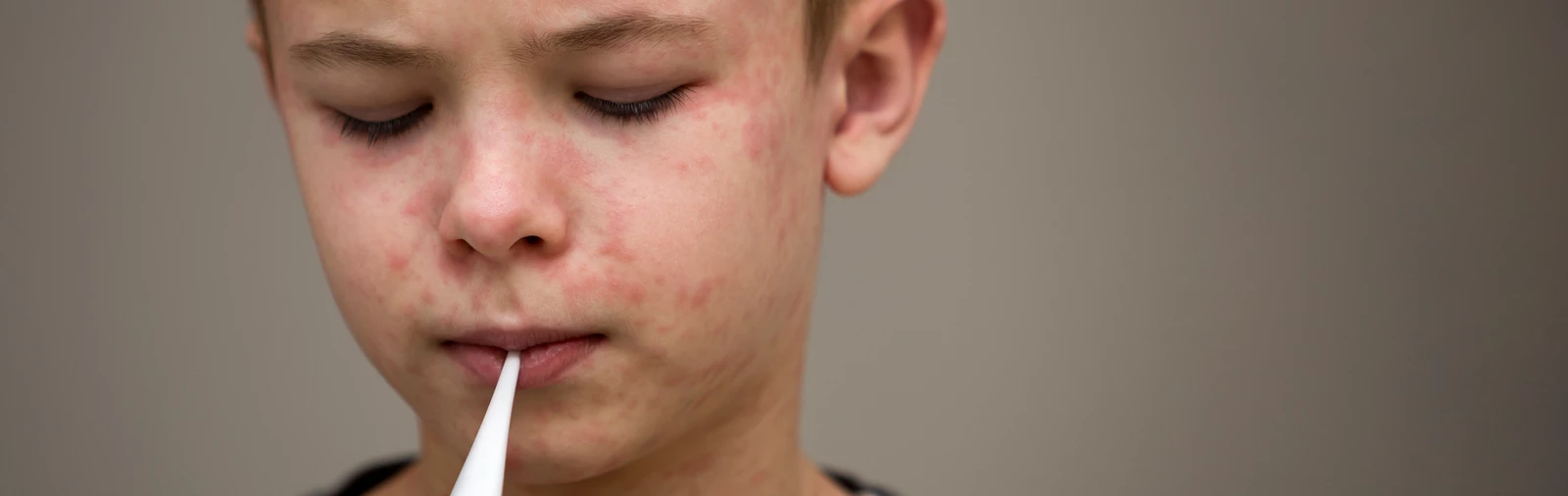 What to Know About Measles Signs and Symptoms