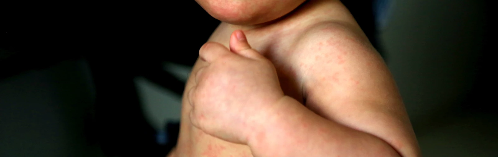 Worried About Measles? Make Sure Your Child Gets the MMR Vaccine.