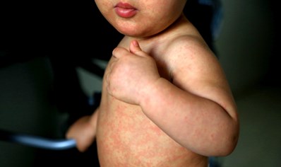 worried-about-measles-make-sure-your-child-gets-the-mmr-vaccine image